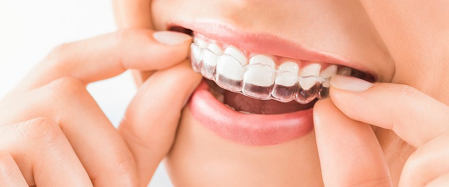 Invisalign